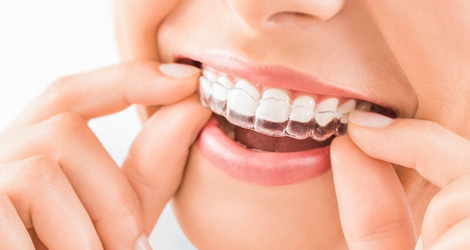 Invisible Braces: A Discreet Path To A Confident Smile